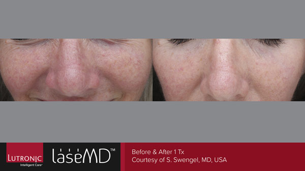 Skin before and after LaseMD treatment