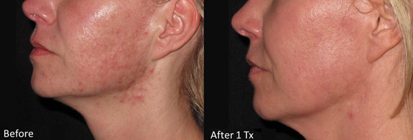 Skin before and after Micro-needling treatment