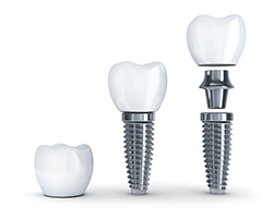 a 3D rendering of a dental implant a 3D rendering of a dental implant