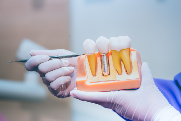 Image of a dental implant 3D model at Dental Care of Burlington in Burlington, MA.