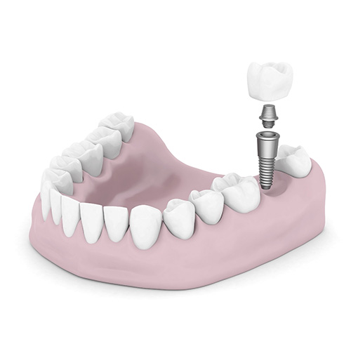 A 3D rendering of a single dental implant