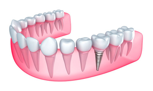 How to Take Care For Your Dental Implants