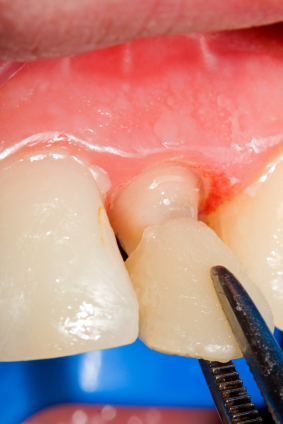 Caring for veneers