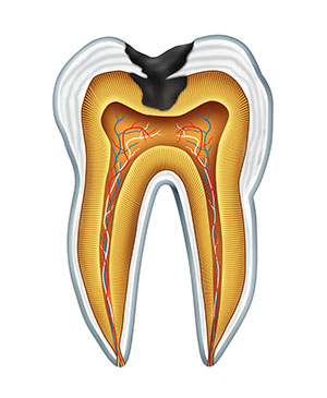 A 3d rendering of a tooth with decay