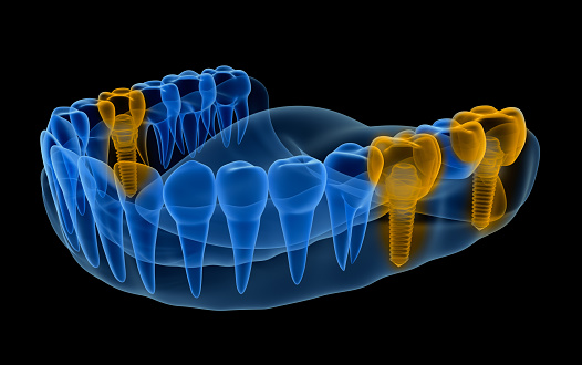 Image of a multiple tooth implant.