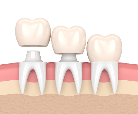 Diagram image of dental crowns, at Dental Care of Burlington in Burlington, MA.