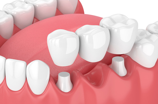 Rendering of jaw with dental bridge at Dental Care of Burlington in Burlington, MA