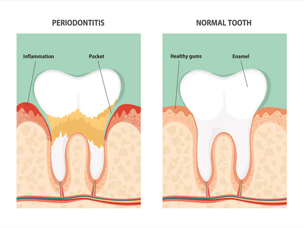 Diagram of periodontitis and health tooth at Dental Care of Burlington in Burlington, MA