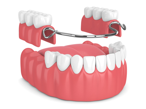 Rendering of removable partial denture at Dental Care of Burlington in Burlington, MA