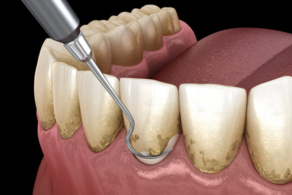 A tooth receiving scaling and root planing therapy at Dental Care of Burlington in Burlington, MA