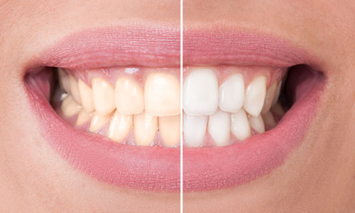 Photo of white teeth done at  Dental Care of Burlington in Burlington, MA