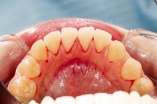 Early Gum Disease Follows a Traditional Pattern 