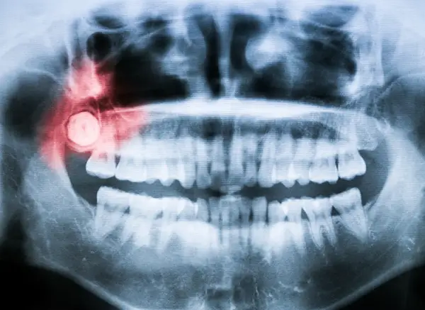 A panoramic dental X-ray with a highlighted area showing an impacted and inflamed wisdom tooth causing pain.